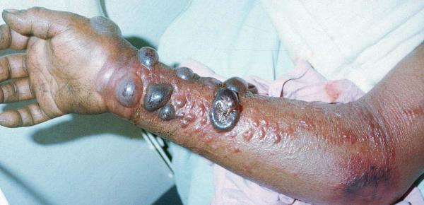 فيروس الإيبولا وفيروس ماربورغ