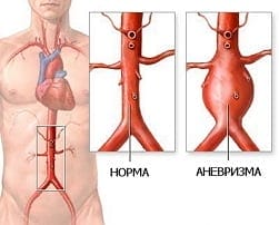 تمدد الأوعية الدموية الأبهرية