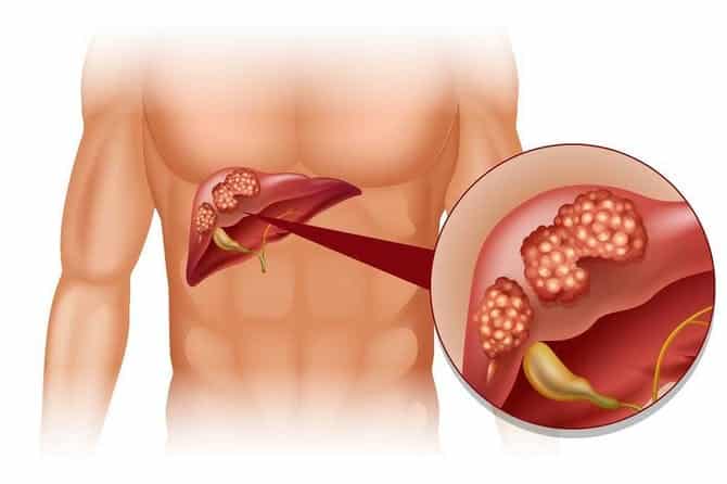 سرطان الكبد – الأنواع و الأعراض وطرق العلاج 1