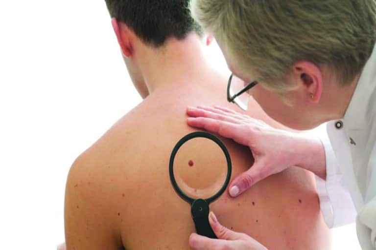أنواع سرطان الجلد 1 والأكثر خطورة تسبب الوفاة