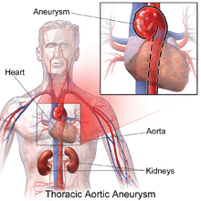 تمدد الأوعية الدموية الأبهري الصدري