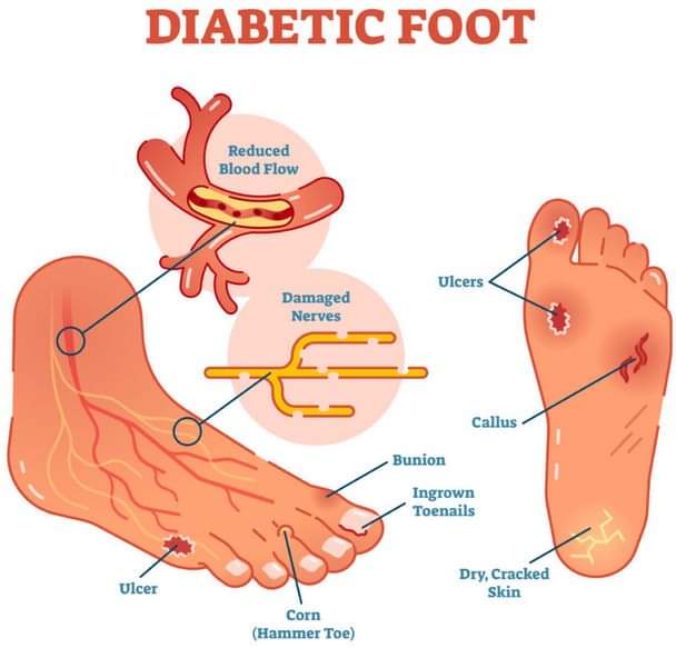 علاج القدم السكري في تايلاند - Diabetes Foot Treatment In Thailand