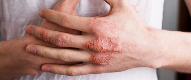 الاكزيما Eczema