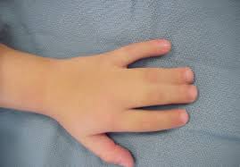 التصاق الأصابع لدي الأطفال ThaiAdvisor1