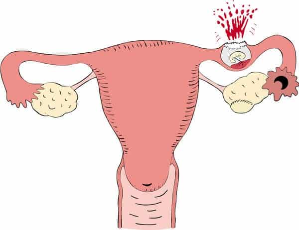 الحمل خارج الرحم ThaiAdvisor1