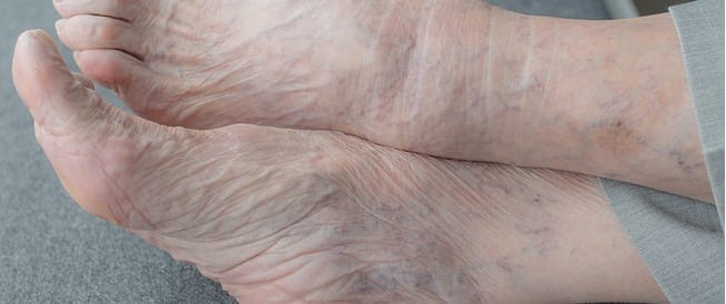 تورم القدمين عند كبار السن الأسباب وطرق العلاج