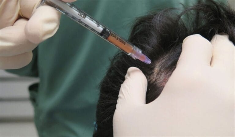 عملية حقن الصفائح الدموية لإنبات الشعر