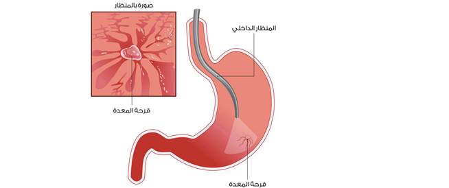 قرحة المعدة Gastric ulcer