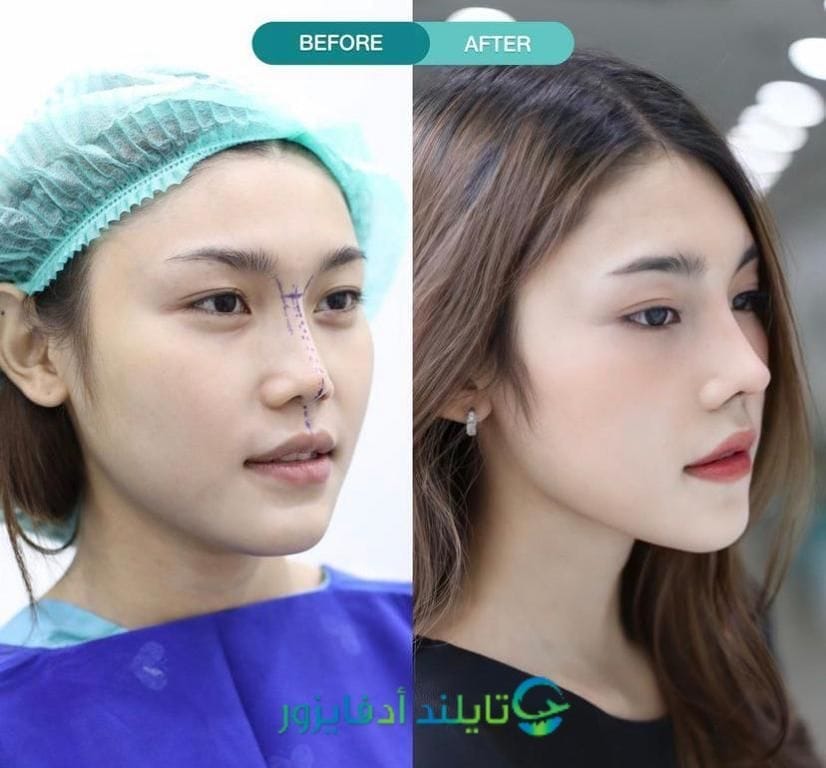 جراحة التجميل في تايلند