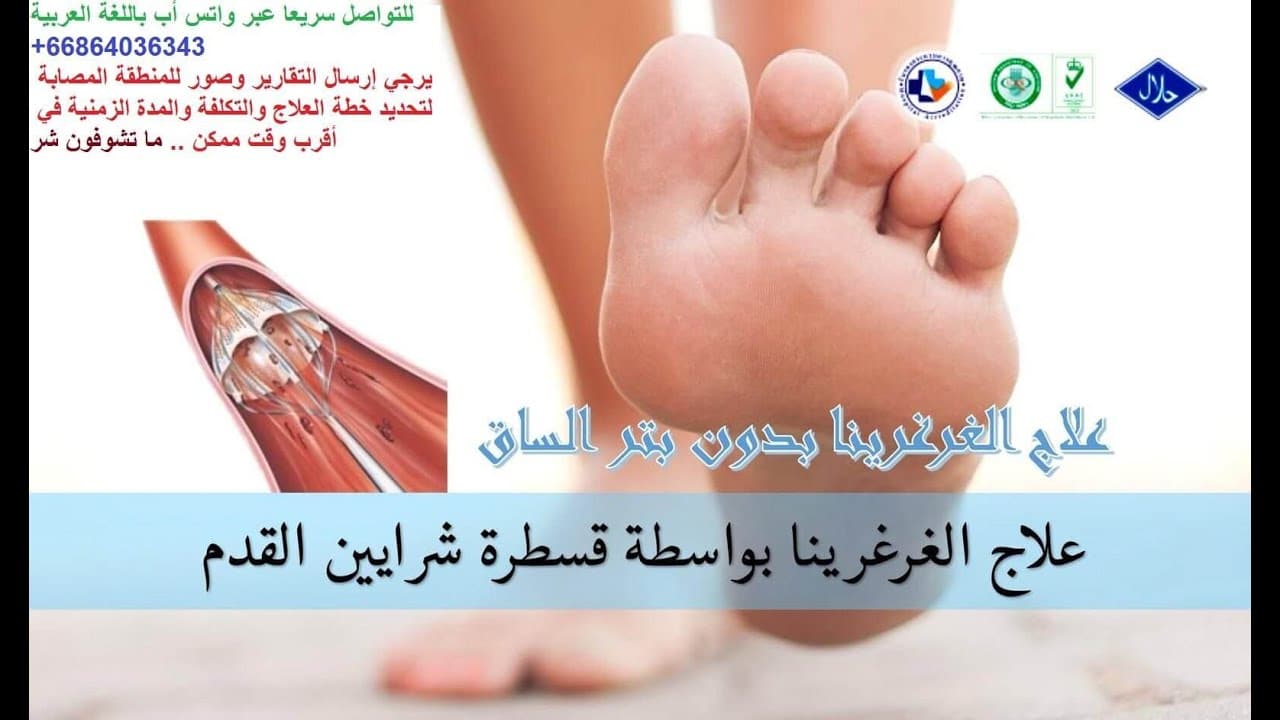 علاج القدم السكري بدون بتر